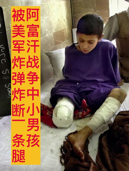丹麦士兵马克·彼得斯阿富汗战场踩雷，双腿被炸烂的悲壮故事